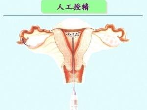 人工受孕的种类及其特点