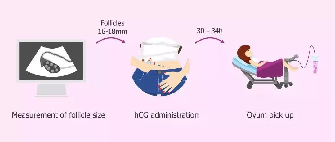 试管婴儿无痛取卵技术，现代生殖医学的崭新篇章