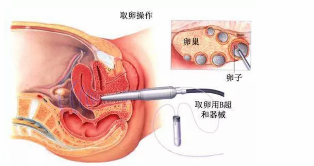 试管取卵打麻药好吗？深入了解与探讨