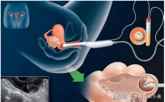 试管取卵麻醉，一种现代医学的细致关怀