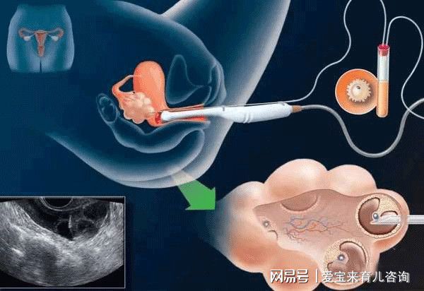 关于取卵前提前排卵，了解、预防与应对措施