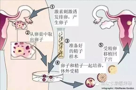 取卵后腹水与移植，深入了解及应对策略