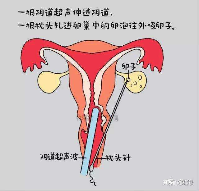 取卵与感冒，女性健康的重要关注点