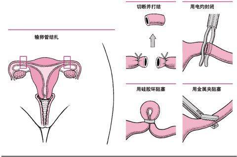 输卵管结扎后如何取卵，方法与注意事项