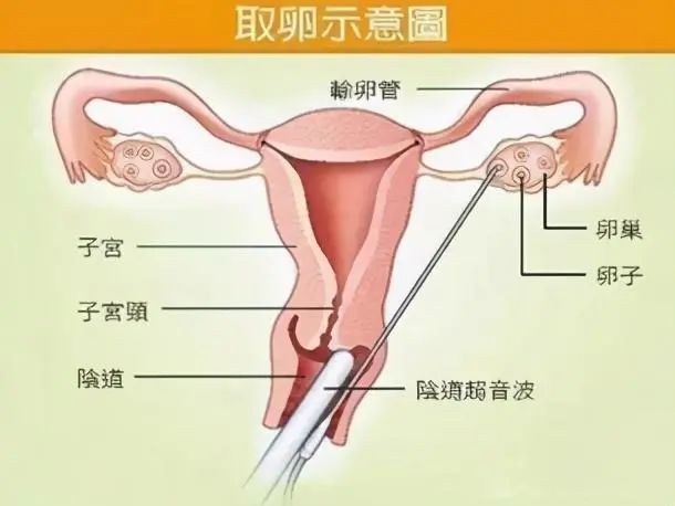 取卵之后，女性身体与心理的多维解读